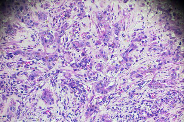 Hepatocellular carcinoma, HCC under microscopy