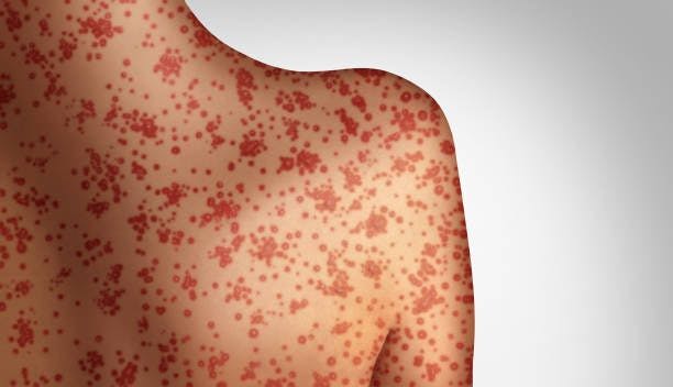 3D illustration of the highly contagious measles on somebody's back.

Image credits: Unsplash
