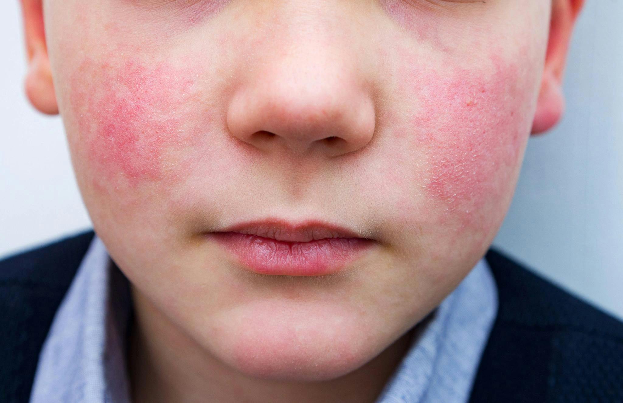 Parvovirus B19 "slapped cheek" rash in children