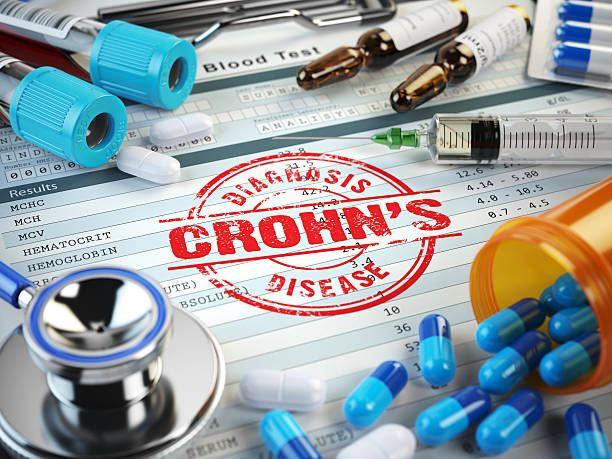 Crohn’s disease relapse is poorly understood, especially in pediatric population. We hypothesized that microbial and inflammatory changes that persist during symptomatic remission might act as potential triggers for relapse.